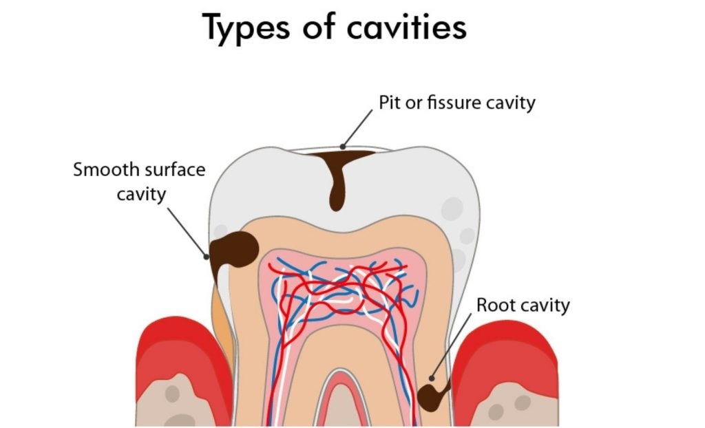 Types of dental caries