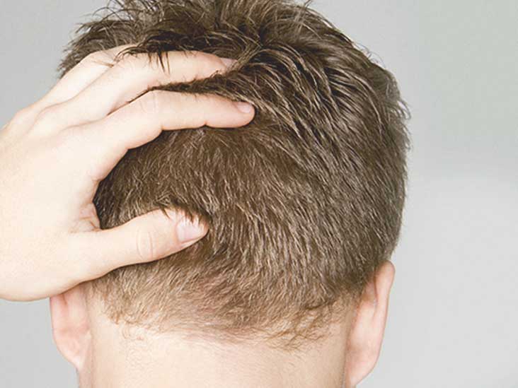 How Beneficial Is Hair Transplant Treatment?