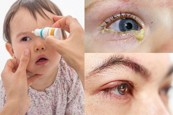 Các loại khác nhau của bệnh đau mắt đỏ ( viêm kết mạc)