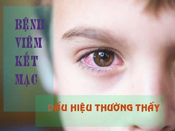 Phương pháp Điều trị Viêm kết mạc mắt